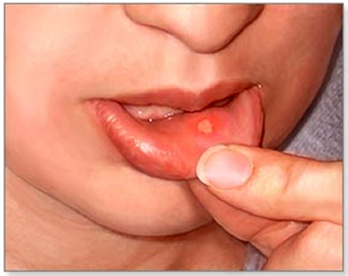 How To Cure Mouth Blisters
